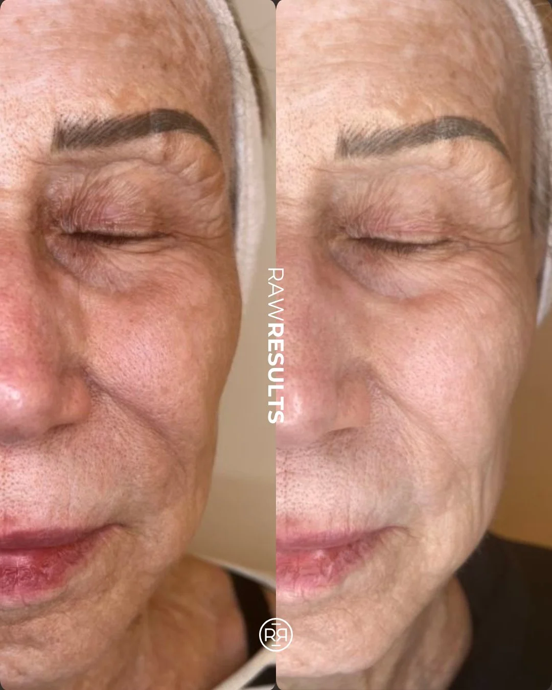 Consistency looks so good on her ✨
This client has been committed to her personalized skincare plan, and the results speak for themselves. Her complexion looks noticeably healthier, lighter, and brighter, with a refreshed glow that keeps building ove