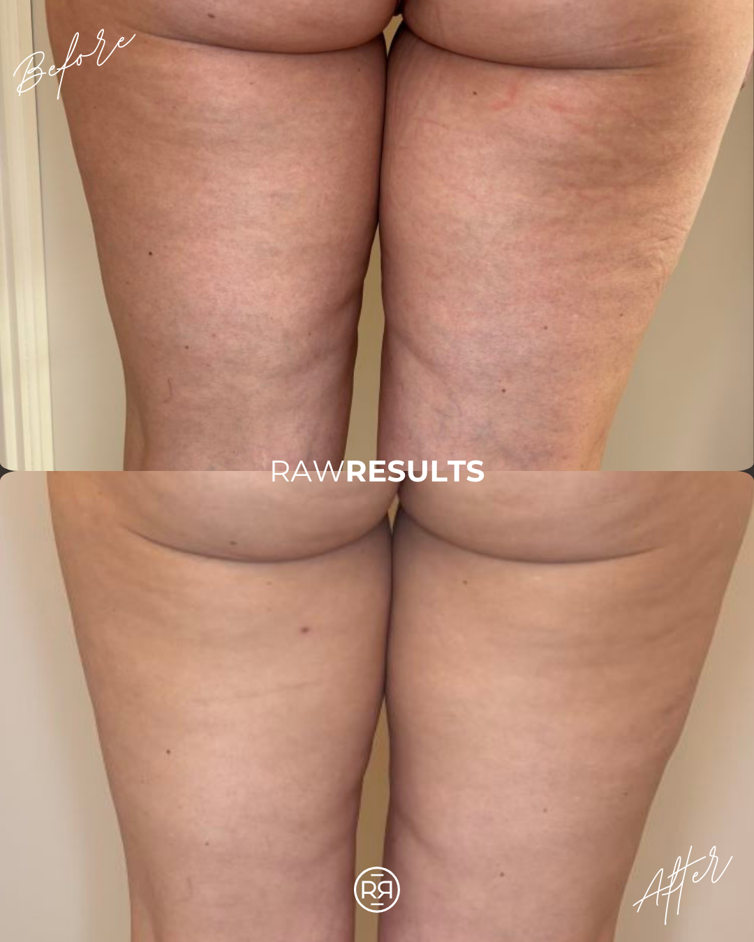 Onda Coolwaves Body Sculpting: The Perfect Finishing Touch After Liposuction in Denver
