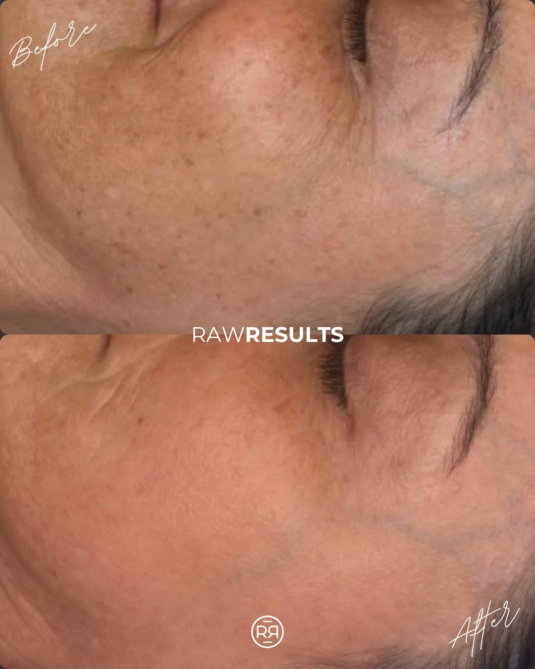 Before ➡️ After 💫
This beautiful transformation is the result of IPL treatments targeting pigmentation and fine lines. Brighter, more even skin with a naturally youthful glow ✨ 

#medicalspa #medicalaesthetics #aesthetician #esthetician #selfcare #d