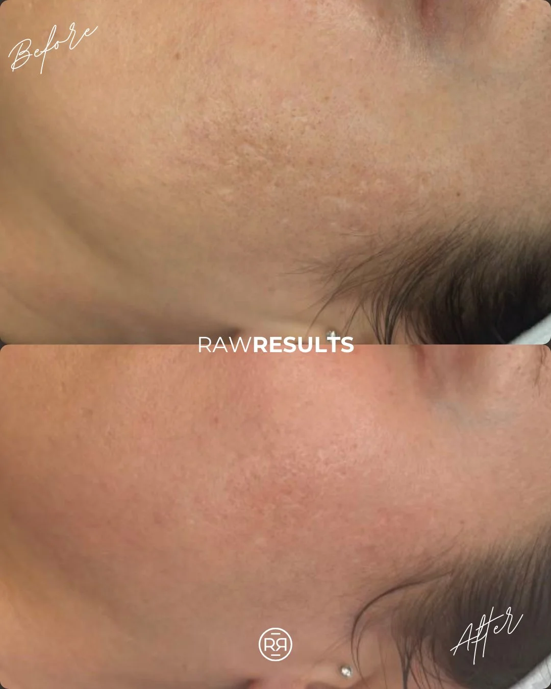 Before ➡️ After ✨
Microneedling can make a powerful difference in skin texture and this transformation is a perfect example. You can see visible improvement and softening of acne scarring, especially through the cheek area.

Treating scars can be cha
