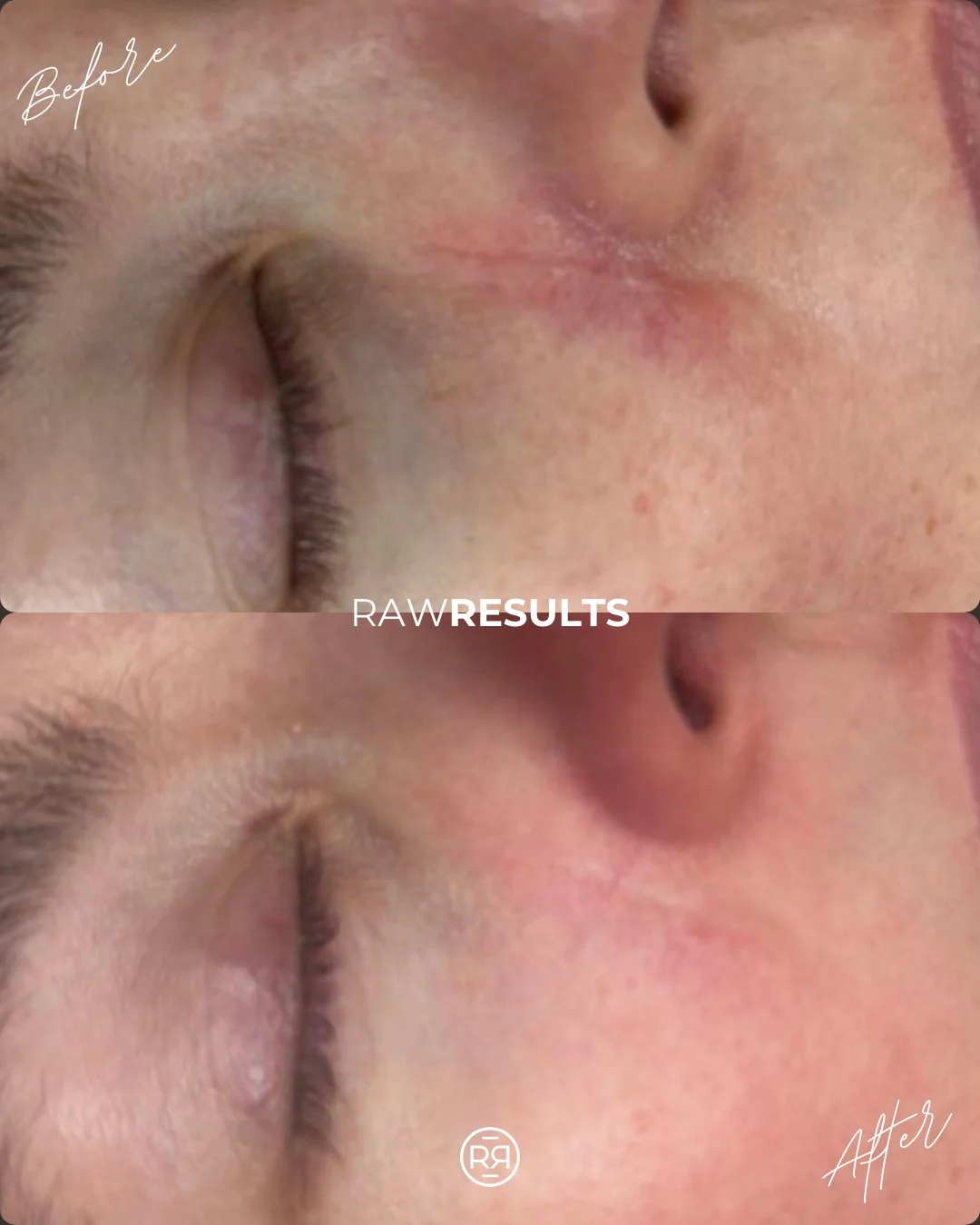 Before ➡️ After 💫
Proof that healing skin is a journey.
This scar revision treatment helped smooth texture and soften pigment&mdash;supporting the skin&rsquo;s natural healing so it looks more even, calm, and healthy.

Same face. Just happier skin ✨