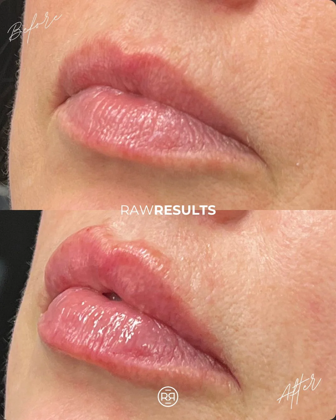 Subtle. Balanced. Still you 💋
This beautiful, natural lip enhancement was expertly done by our amazing nurse injector Melissa&mdash;refining shape and softness without ever overdoing it.

Healthy lips. Thoughtful filler. ✨ 

#rawrituale #medicalspa 