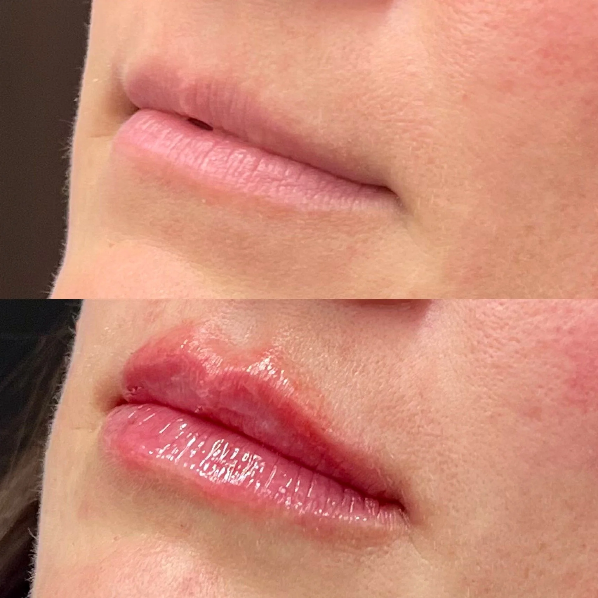 Natural Lip Filler in Denver at Raw Rituale Med Spa