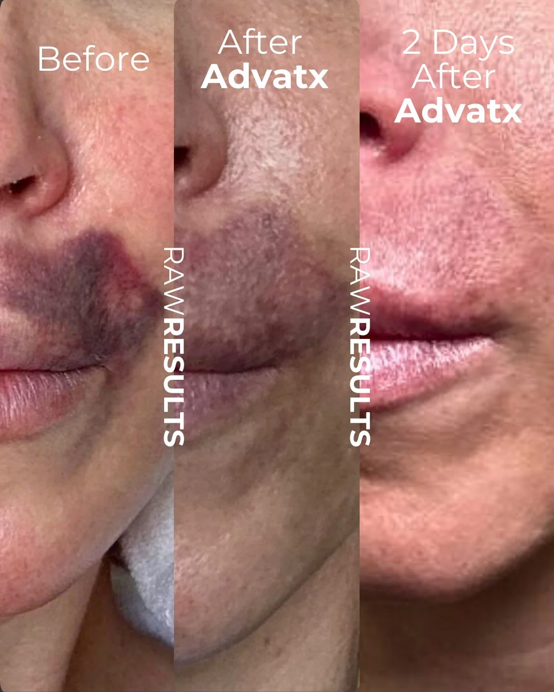 From deep purple to barely there in just ✨2 days✨

Bruising doesn&rsquo;t have to linger for weeks &mdash; with ADVATx, we can dramatically speed up the healing process and visibly reduce discoloration fast.

Why it works 👇
ADVATx uses dual-waveleng