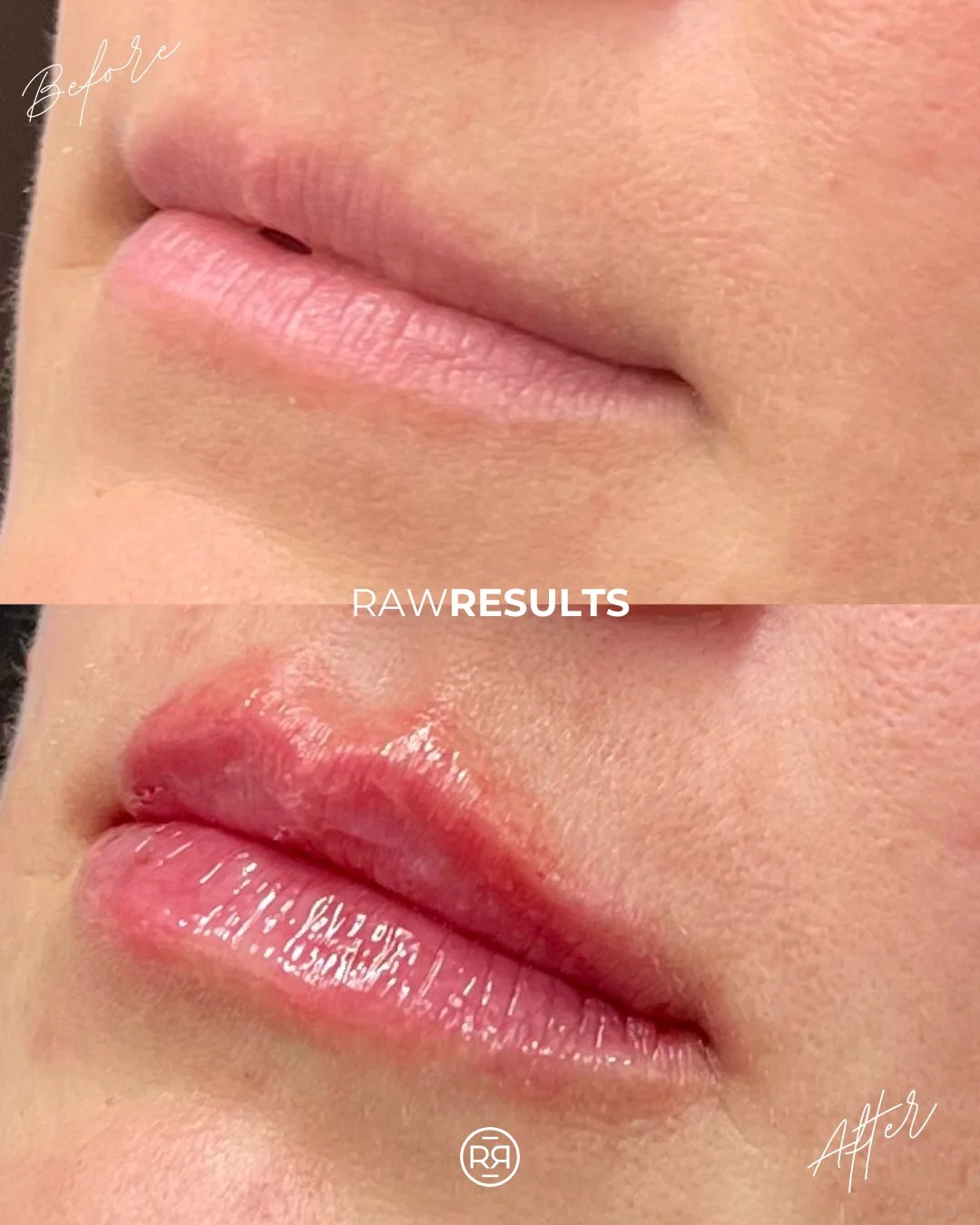 Soft, subtle, and balanced ✨ A slight increase in volume with beautifully enhanced structure &mdash; just enough to define and refine while keeping everything natural. Effortless enhancement that still feels completely you. 💋 

#rawrituale #medicals