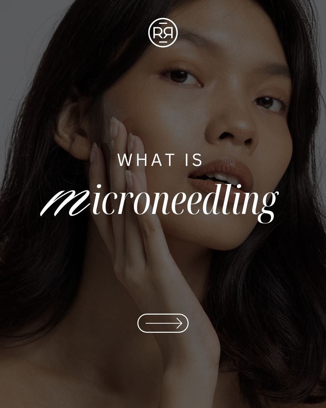 Microneedling = collagen, renewal, and healthier skin from within ✨

This treatment creates tiny micro-channels that stimulate your skin&rsquo;s natural healing process, helping improve texture, soften fine lines, minimize acne scars, and support lon