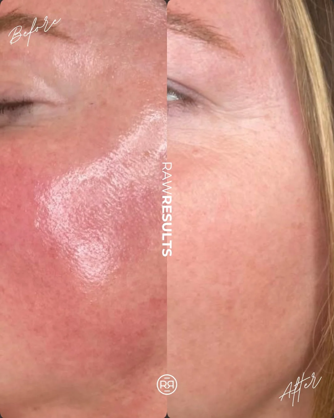 Redness, reduced ❤️✨

ADVATx = calmer, clearer, stronger skin
✨ Targets redness, rosacea + acne
✨ Improves tone + texture
✨ Boosts collagen over time

Skin health, elevated 🤍 

#rawrituale #medicalspa #medicalaesthetics #aesthetician #esthetician #s