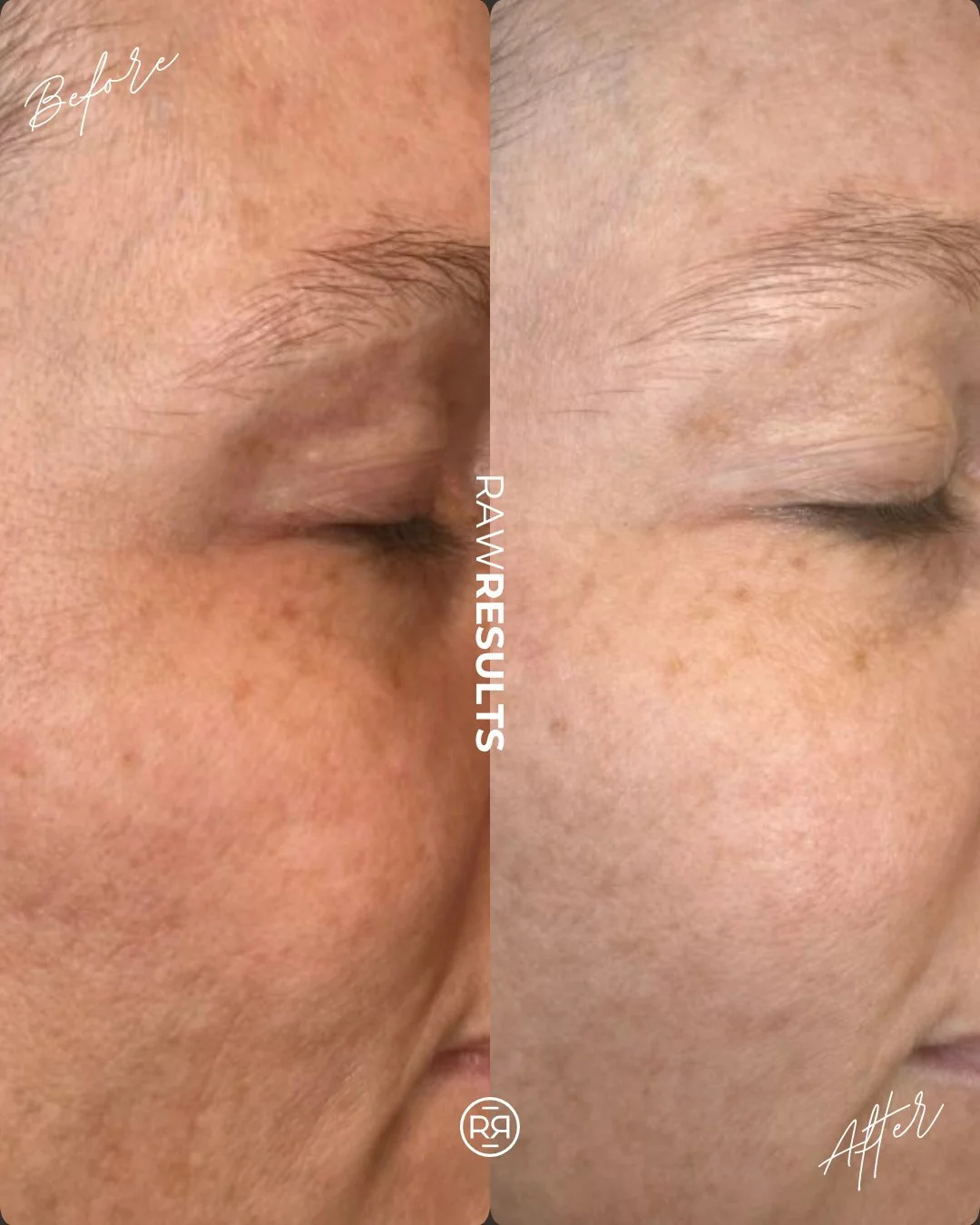 Brighter. Smoother. Healthier ✨

Consistency + the right treatments = real results 🤍
(ADVATx, microneedling &amp; her first Tixel 👏)

Loving these results already, and we can&rsquo;t wait to see how it continues to improve! 

#advatx #antiaging #an