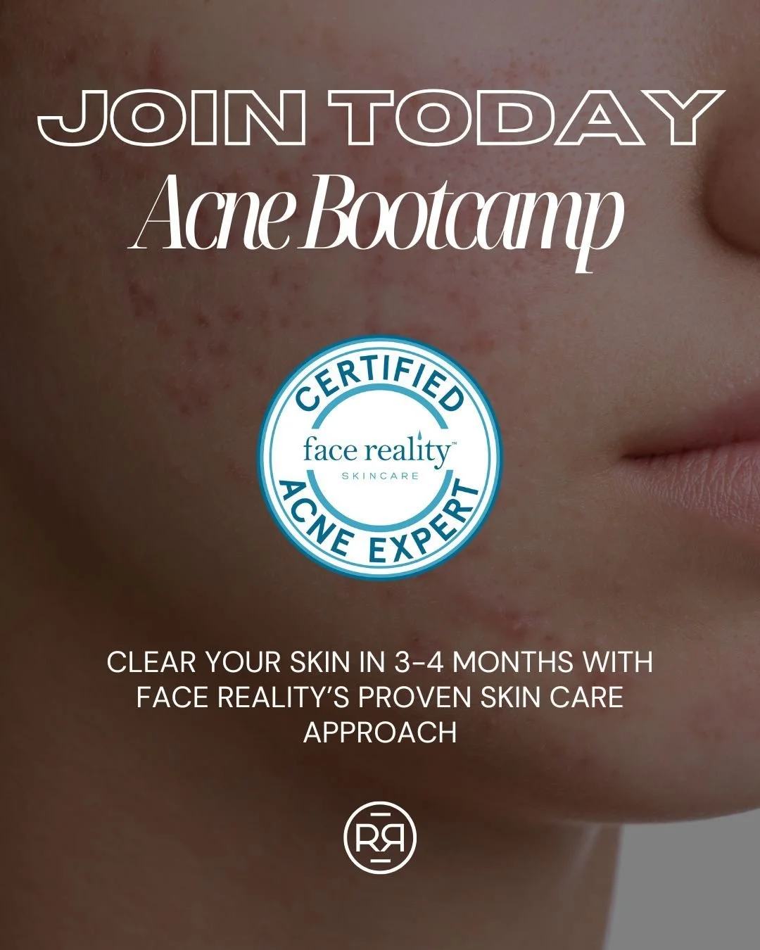 Struggling with acne? You&rsquo;re not alone and we get it 💛

Audrey is a certified Face Reality Acne Expert, and she&rsquo;s been in your shoes. Her own journey with acne is what inspired her to dive into skincare and help others feel confident in 