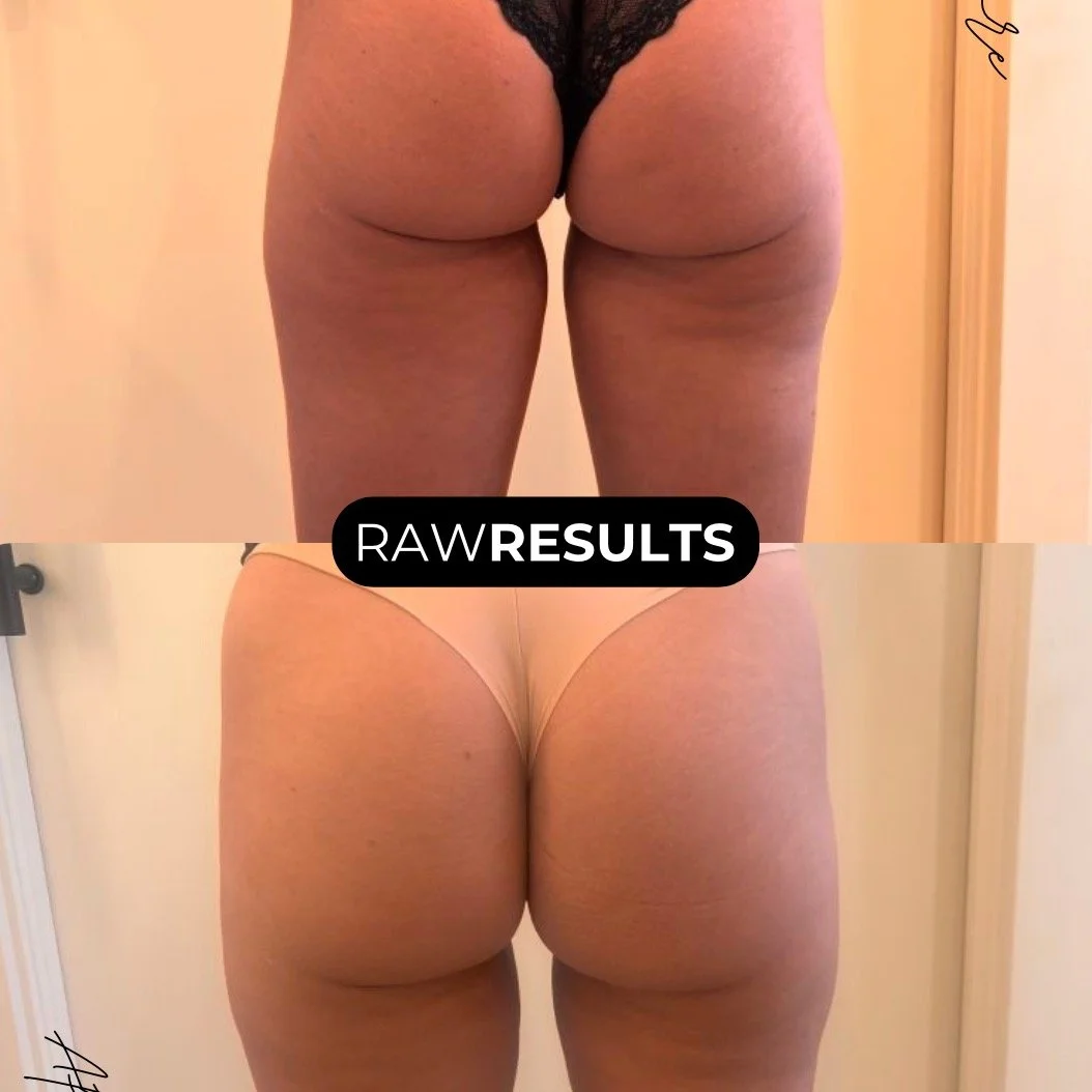 RAW RESULTS ✨
This is what real, consistent body sculpting looks like.
Top photo: April 8
Bottom photo: April 24
Just over 2 weeks apart and you can already see visible smoothing and contouring 👀
For this client, we focused on:
&ndash; the banana ro