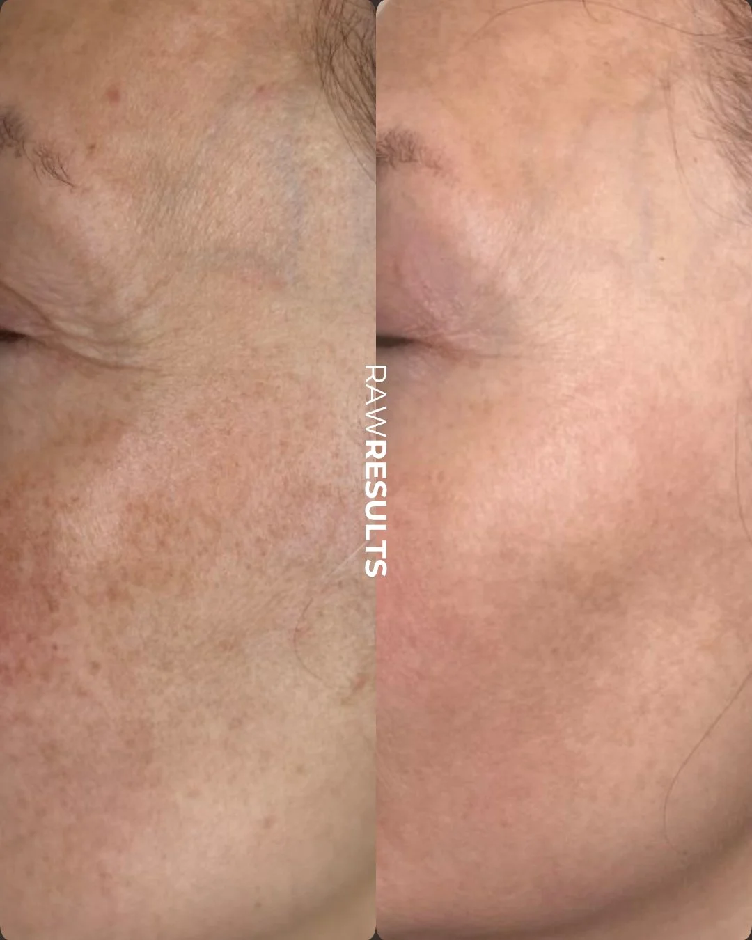 Consistency creates results ✨

Brighter, tighter, healthier skin doesn&rsquo;t happen overnight &mdash; it happens by staying committed to a customized treatment plan and trusting the process. So proud of these beautiful before + after results 🤍

He