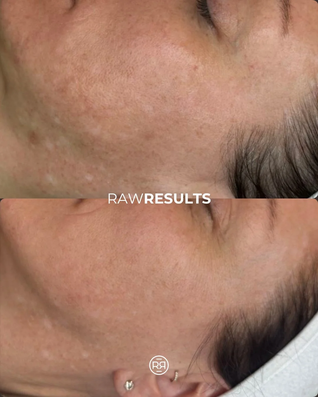 A brighter, more even skin tone makes all the difference ✨ 

#rawrituale #medicalspa #medicalaesthetics #aesthetician #esthetician #selfcare #denvermedspa #denvermedicalspa #denvermedicalaesthetics #denverbeauty #skin #skincare #skincareroutine #skin