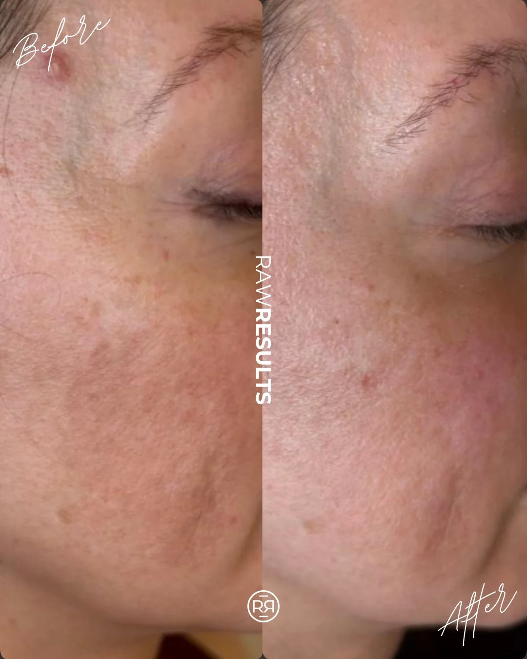Nothing better than seeing skin become brighter, smoother, and more even 🤍 

#rawrituale #medicalspa #medicalaesthetics #aesthetician #esthetician #selfcare #denvermedspa #denvermedicalspa #denvermedicalaesthetics #denverbeauty #skin #skincare #skin