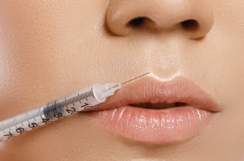 Lip Filler: What It Is, What It Isn't, and Common Misconceptions