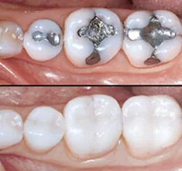 32D-ToothColored-Restoration.jpg