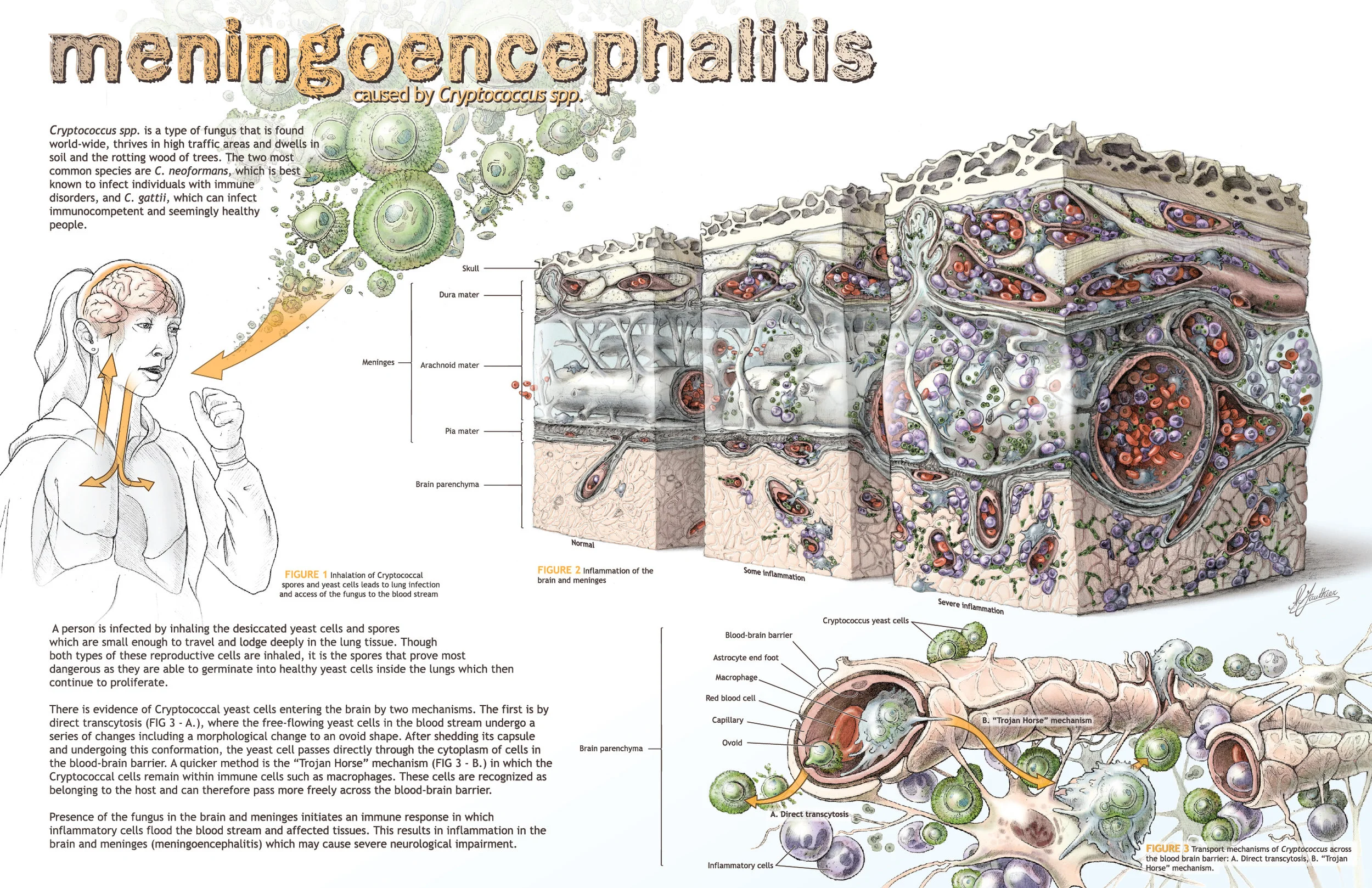 gauthier_Meningoencephalitis.jpg