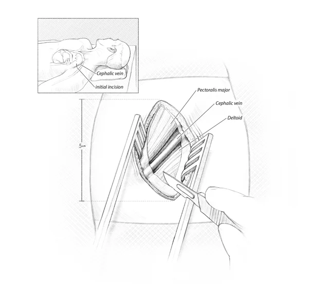Gauthier_pacemaker_Step1.jpg