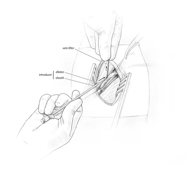 Gauthier_pacemaker_Step3.jpg