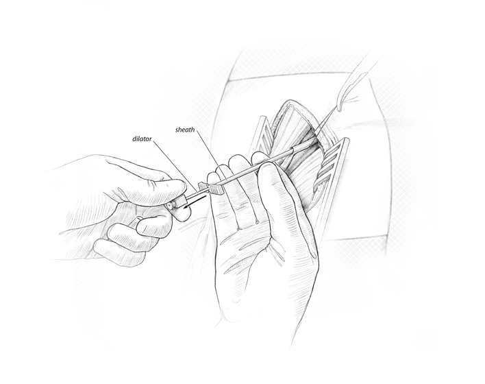 Gauthier_pacemaker_Step4.jpg