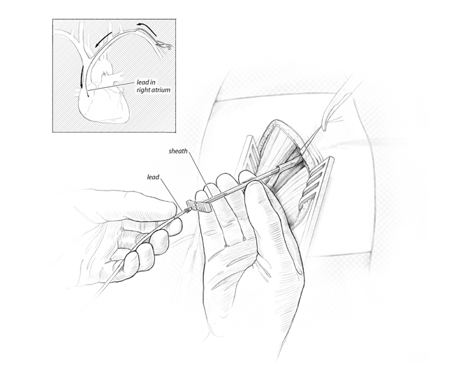 Gauthier_pacemaker_Step5.jpg