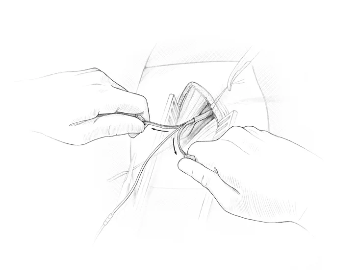 Gauthier_pacemaker_Step6.jpg