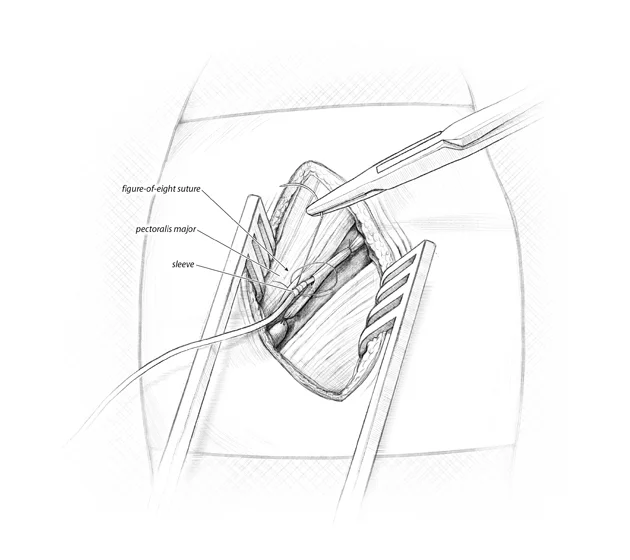 Gauthier_pacemaker_Step8.jpg