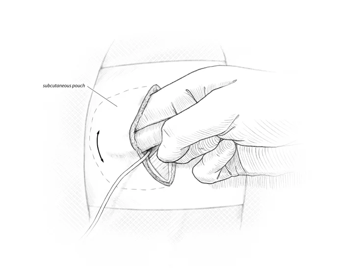Gauthier_pacemaker_Step9.jpg