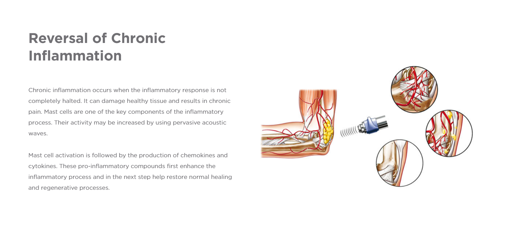 Chronic Inflammation.PNG