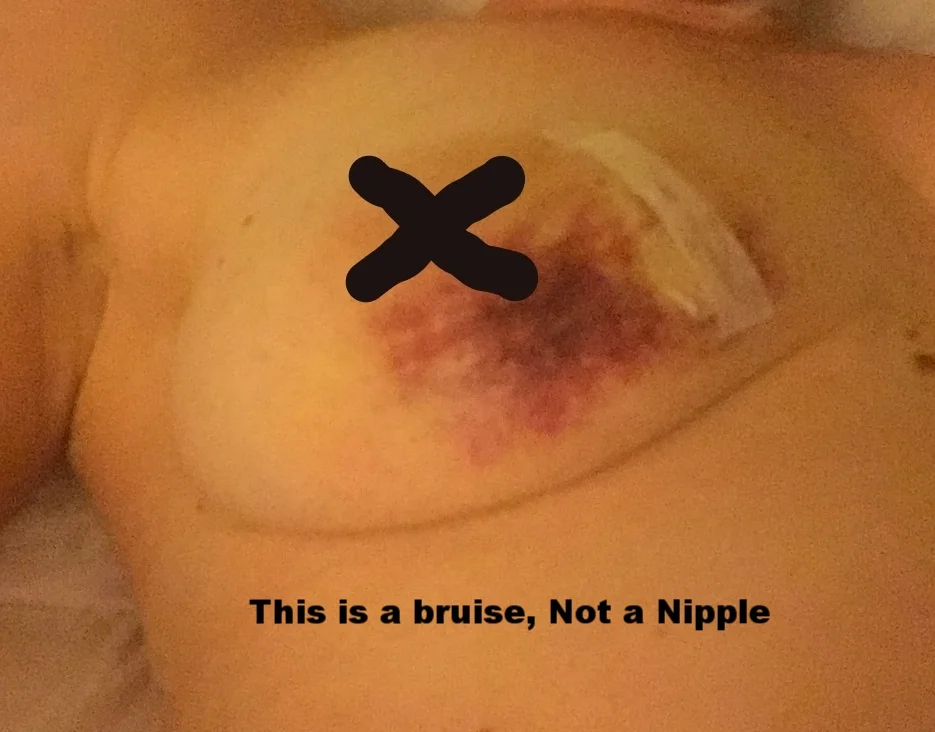 8. Needle biopsies, or when someone treats your tit like a punching bag, just FYI.