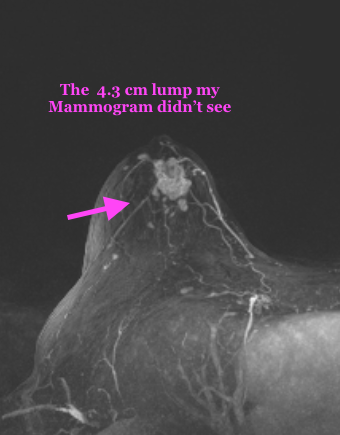 59. It's Breast Cancer Awareness Month, feel yourself up...Or how my fingers found what a mammogram didn't show