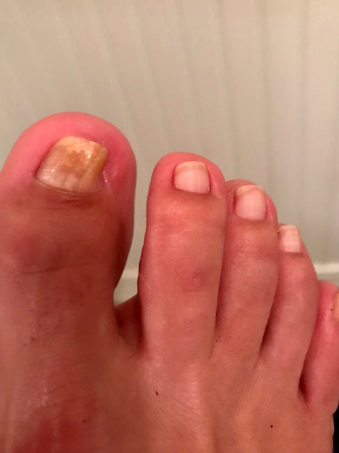 Gnarly toes, August 2018 (one month after starting Vicks).