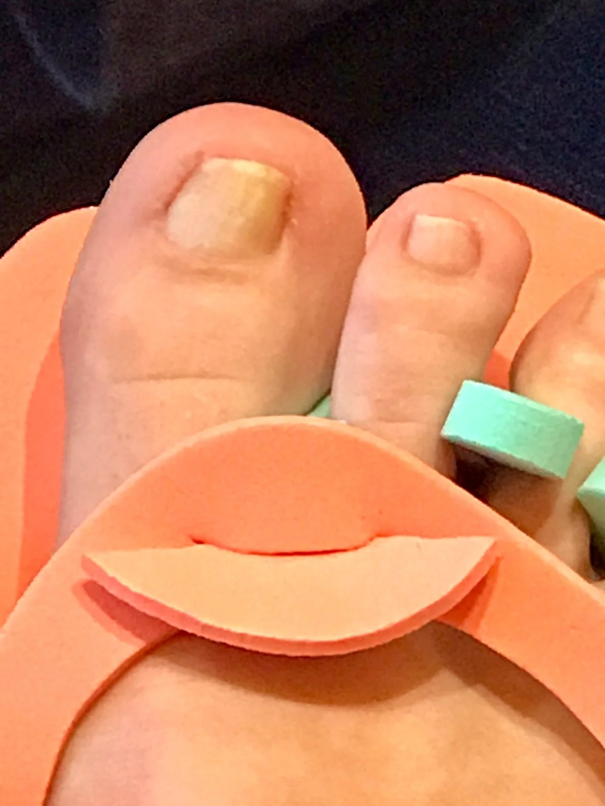 (Not as) gnarly toes, April 2019 (nine months into using Vicks).