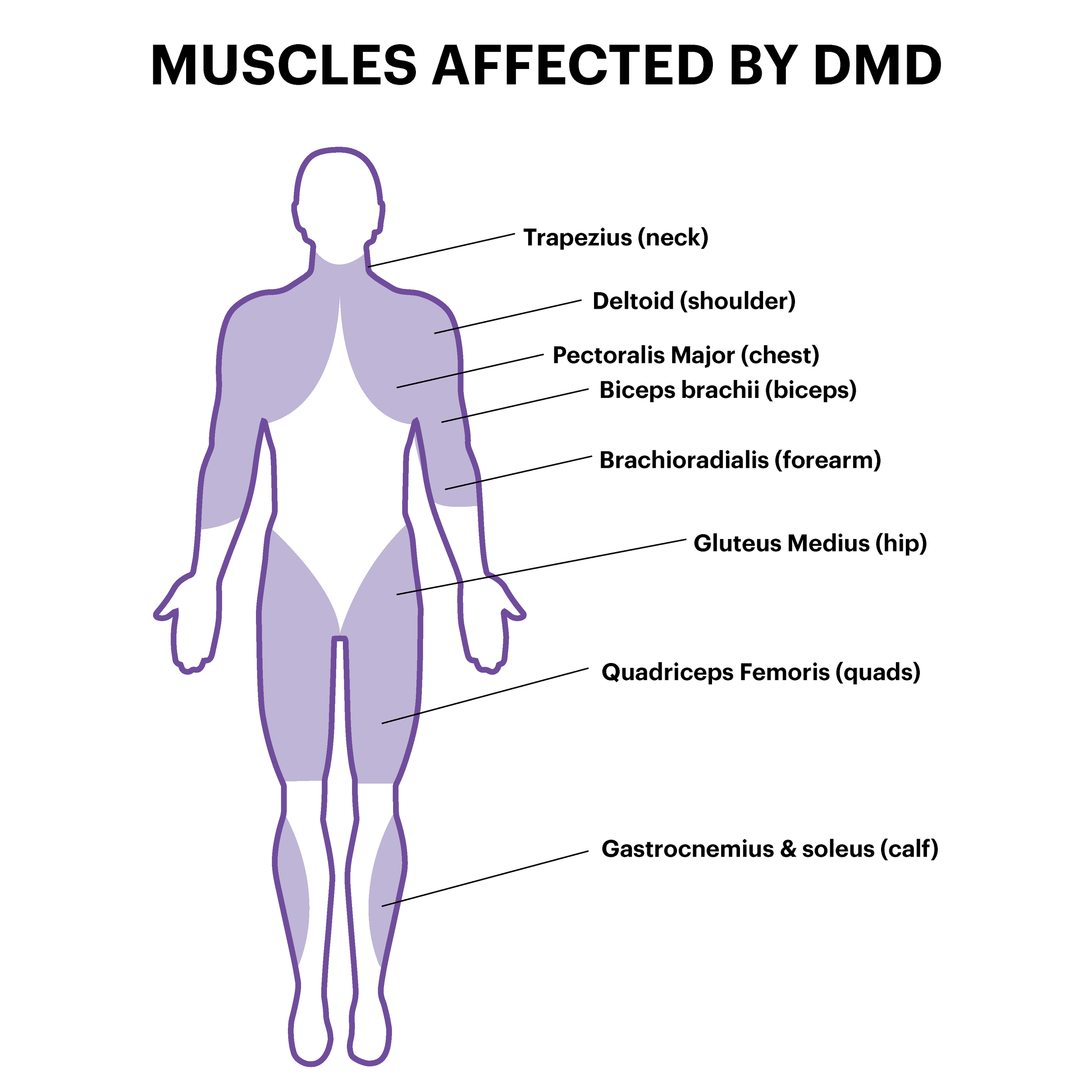 Duchenne Muscular Dystrophy Muscular Dystrophy WA what-is-tmj-hutto-hippo