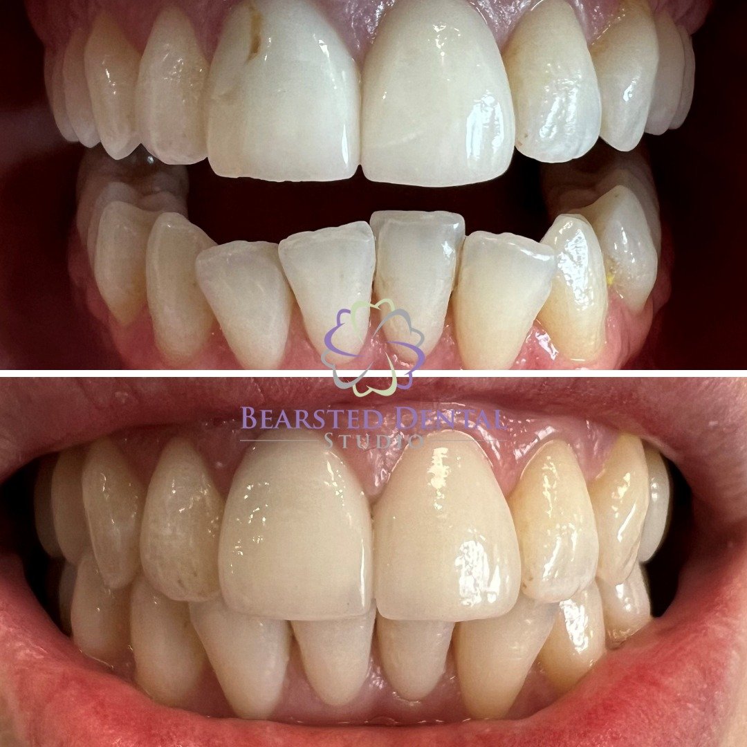 Transformation Time! 😁 

Check out these amazing before and after shots of our patient's smile after straightening their teeth! From misaligned to marvellous, we love seeing the difference a straight smile can make. Ready to transform your grin? Sch