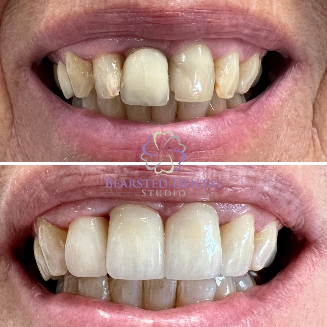 Yet another amazing transformation achieved for one of our valued patients! 😁✨

Our patient is very happy and now able to smile in public - and she said that she should have done this while ago!

If you're dreaming of a smile makeover like this, don