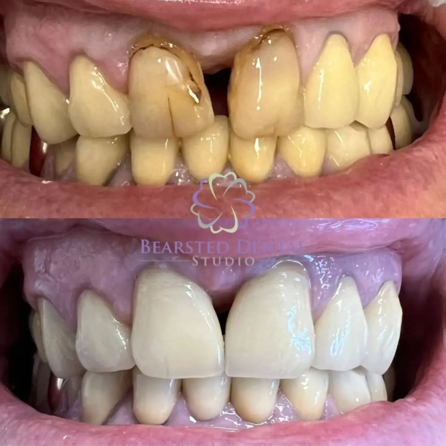 ✨ Smile Transformation Alert! ✨

We just helped another patient achieve their dream smile, and we couldn&rsquo;t be more excited about the results! 😁 Nothing makes us happier than seeing that confidence shine through after a smile makeover.

If you&
