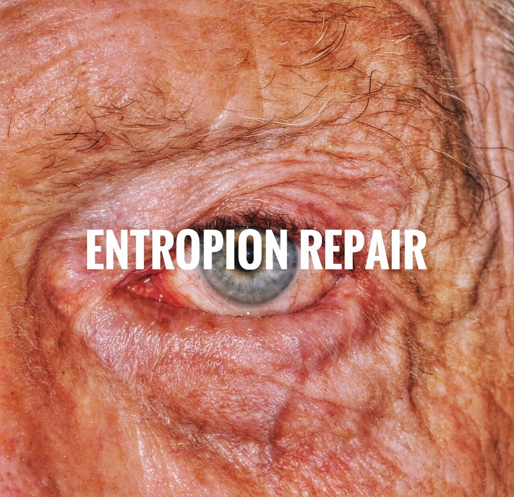 what is entropion surgery