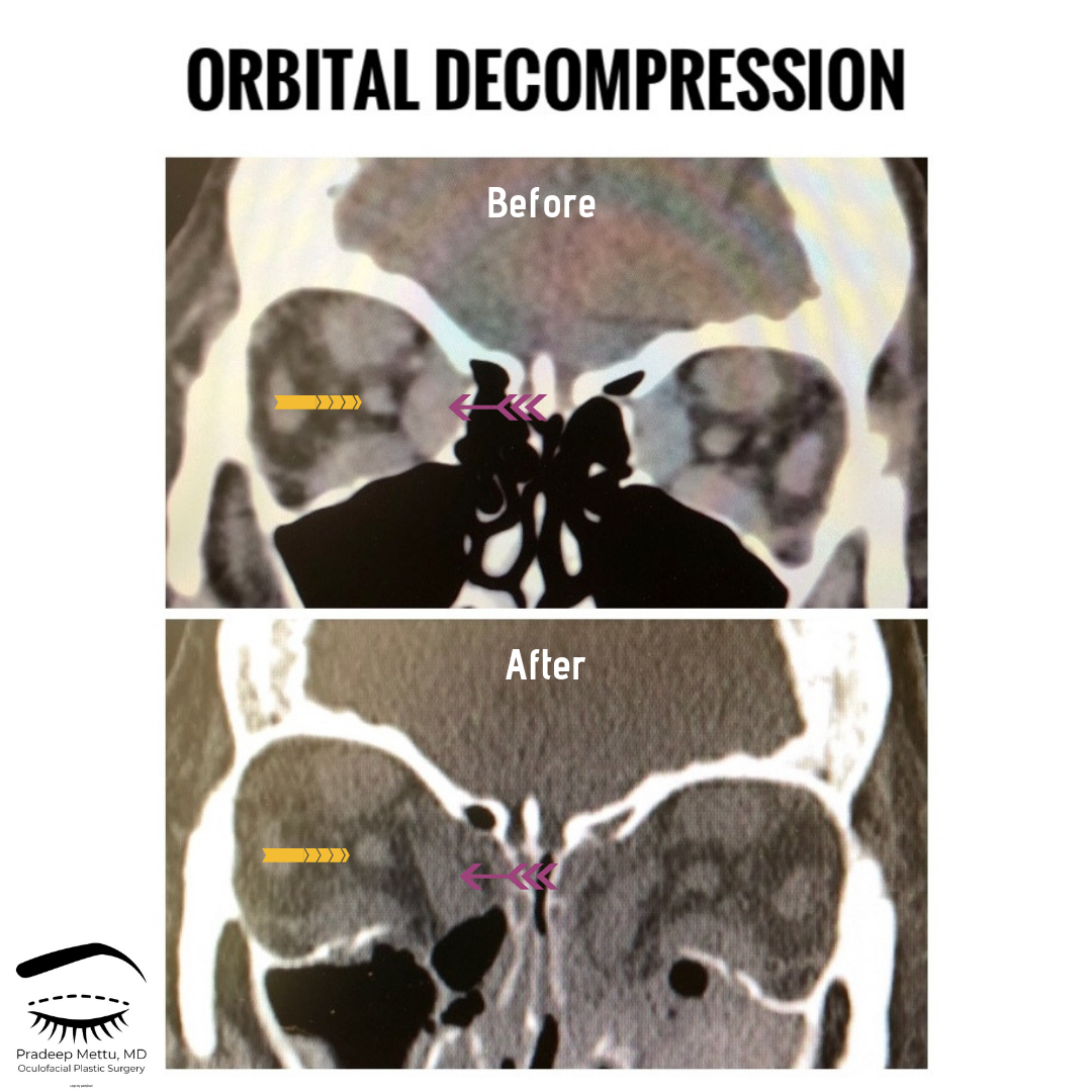 Thyroid Eye Disease Raleigh Eye and Face Plastic Surgery