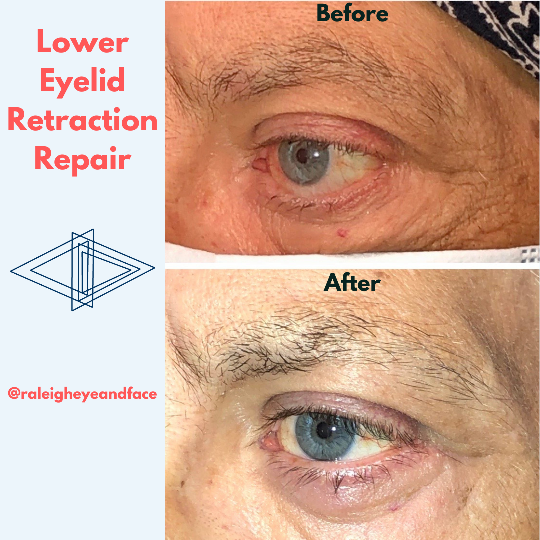 Eyelid Retraction Repair - Raleigh Eye 