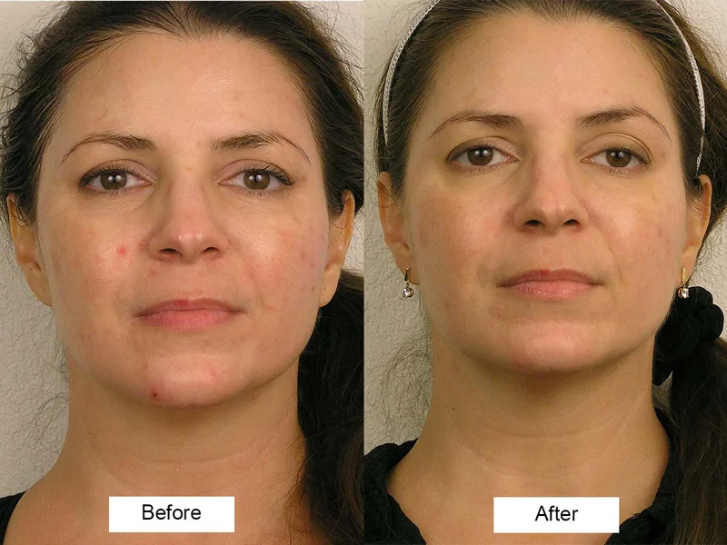 Microcurrent Simply Skin Esthetics