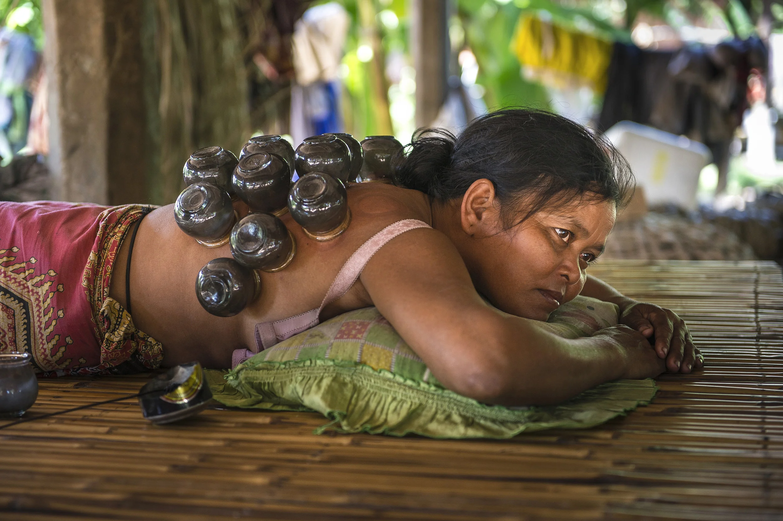 CUPPING THERAPY