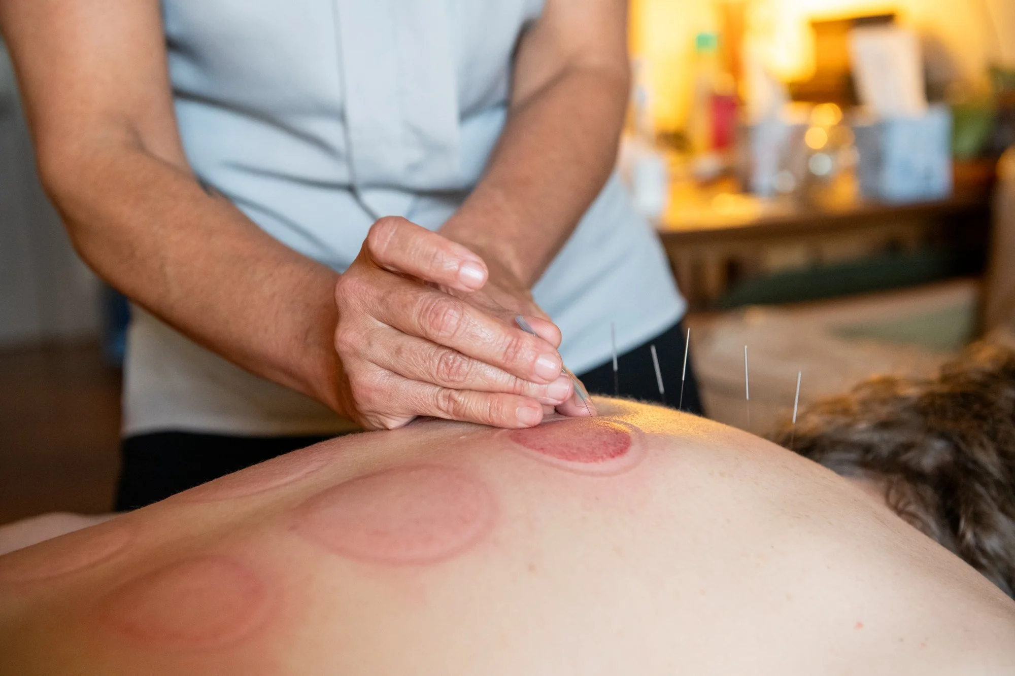 julie-acupuncture-14.jpg