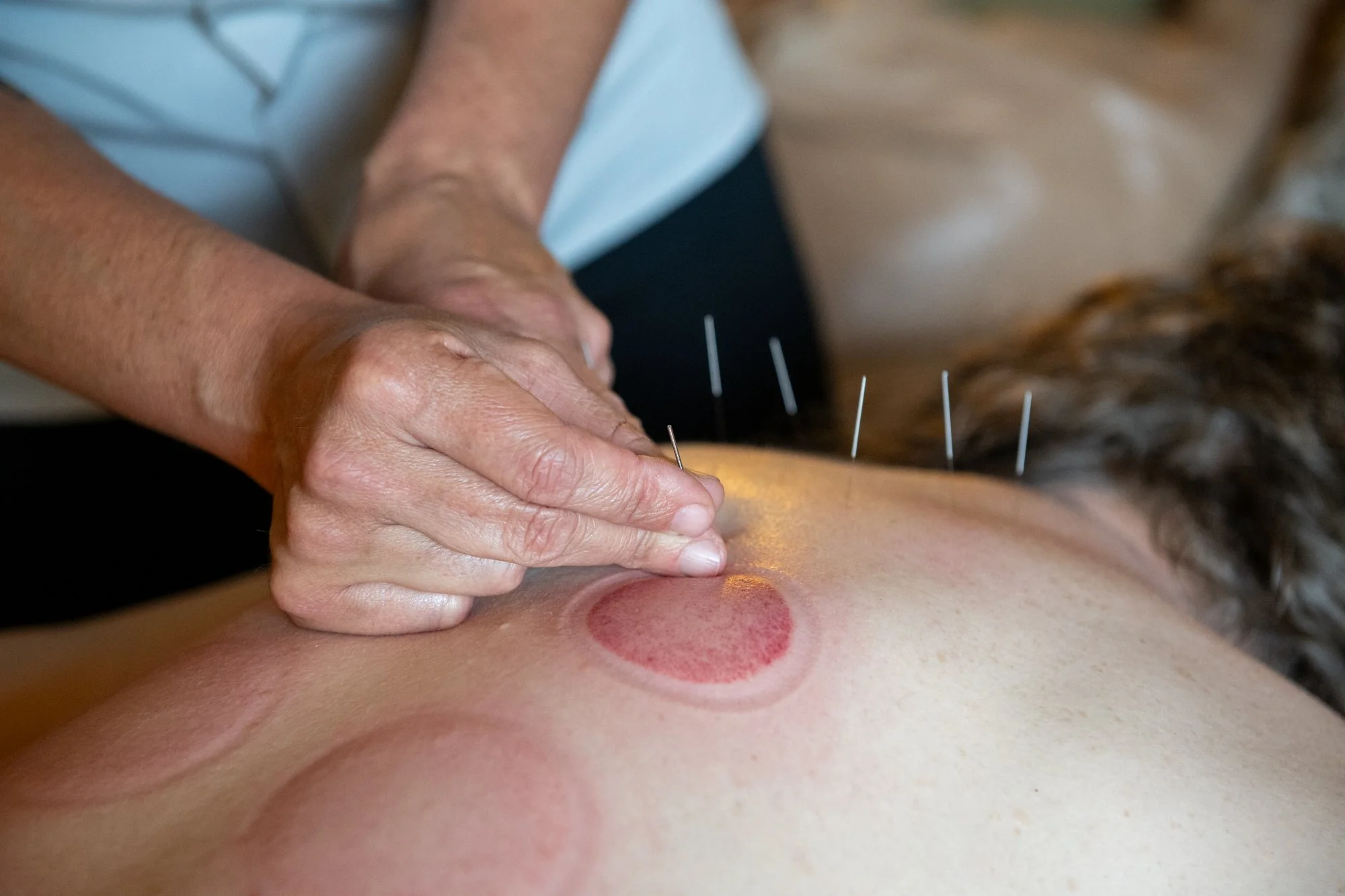 julie-acupuncture-16.jpg