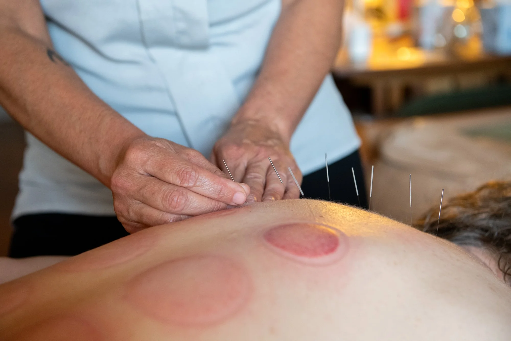 julie-acupuncture-21.jpg
