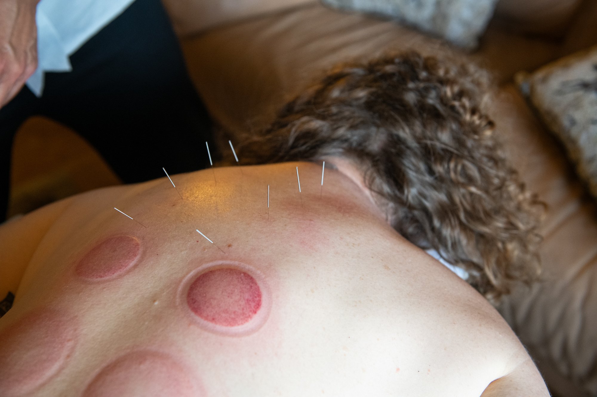 julie-acupuncture-23.jpg