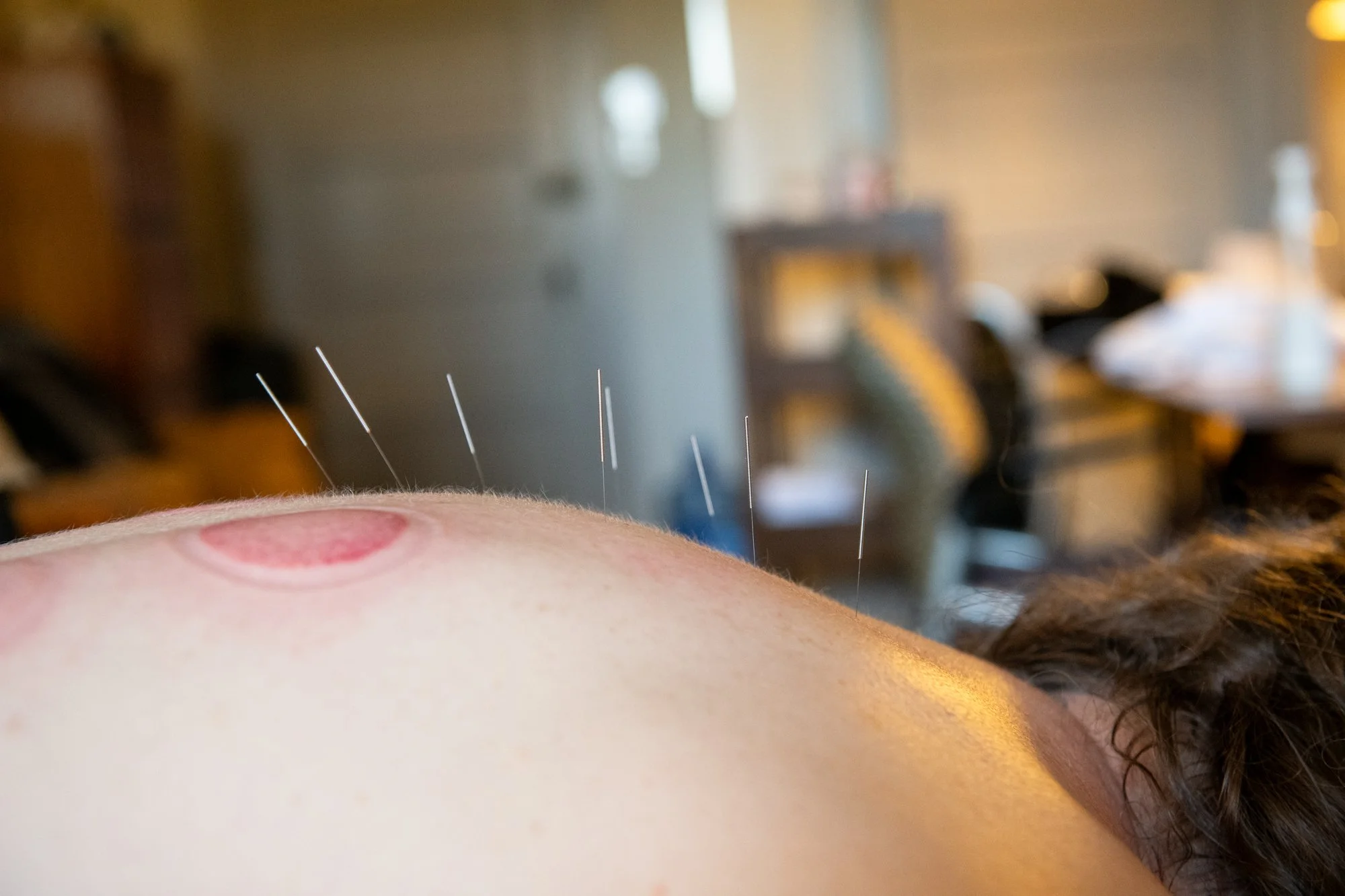 julie-acupuncture-26.jpg