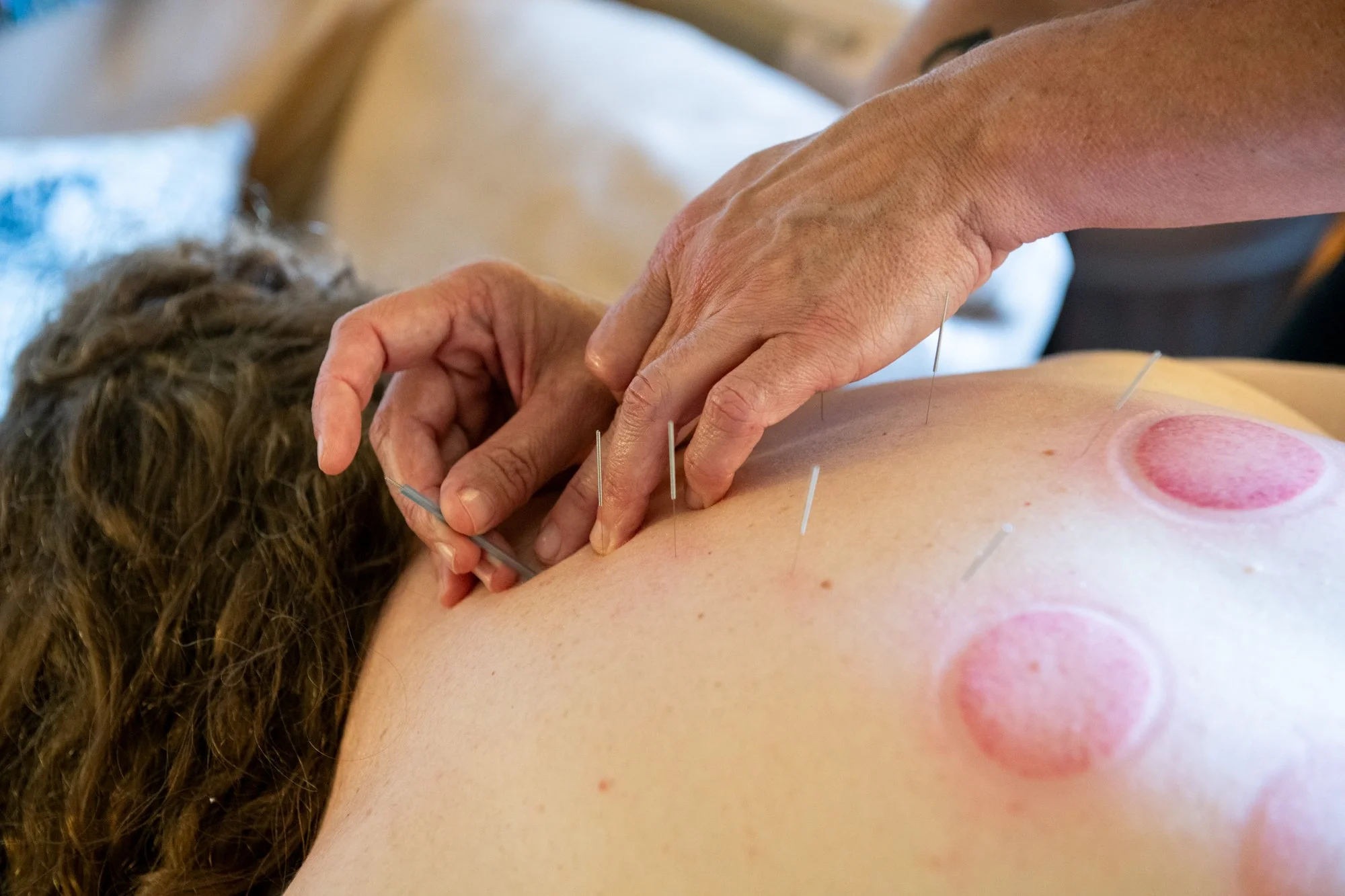 julie-acupuncture-30.jpg