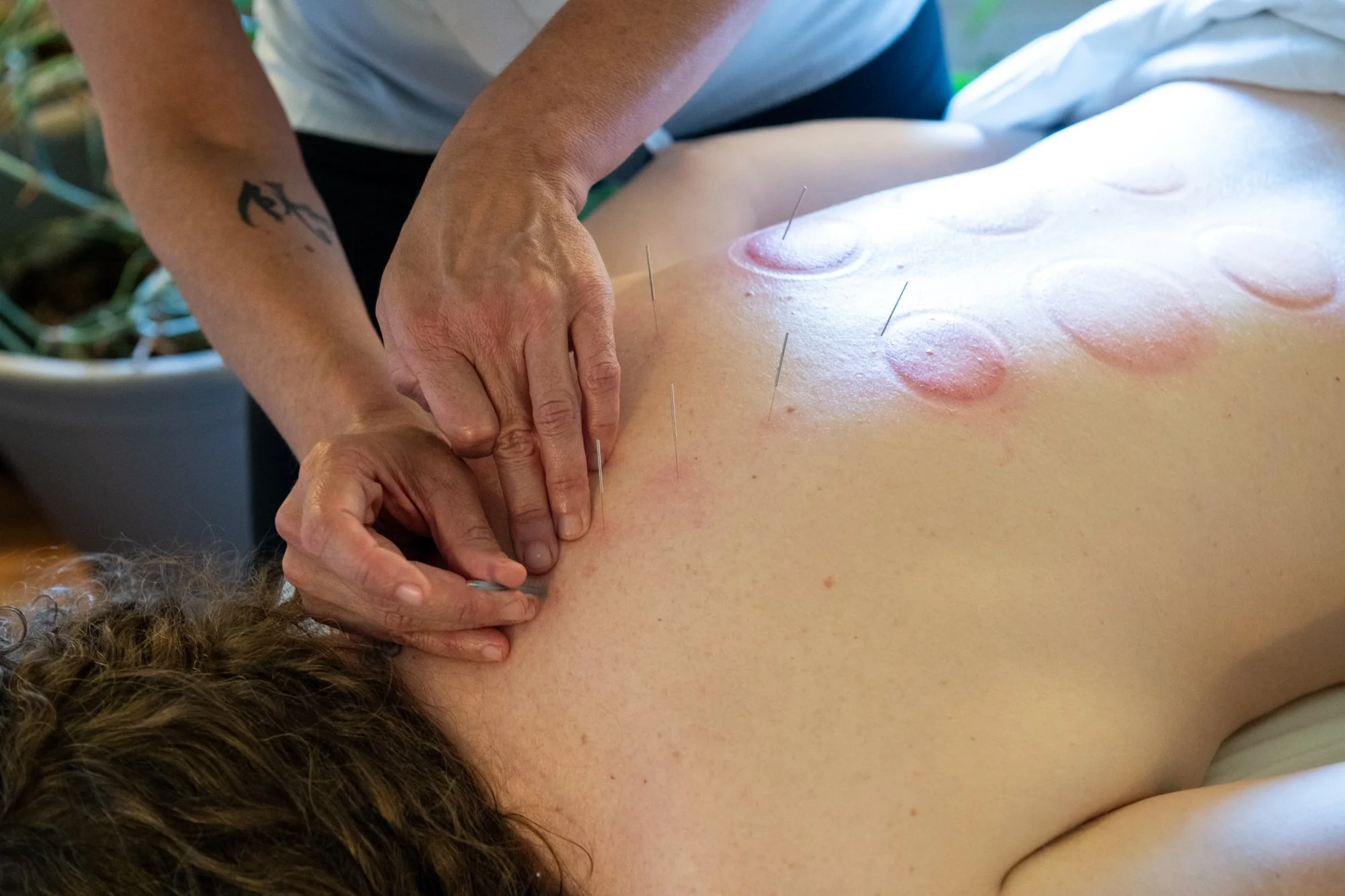 julie-acupuncture-31.jpg