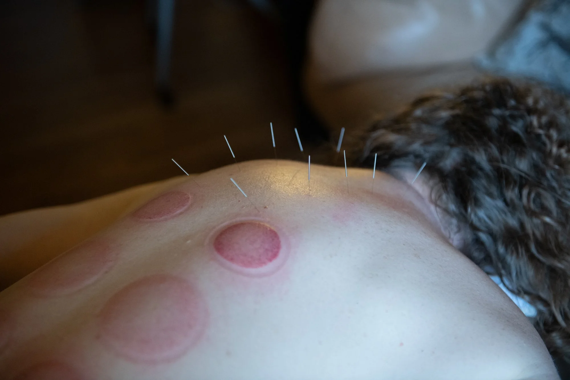 julie-acupuncture-41.jpg