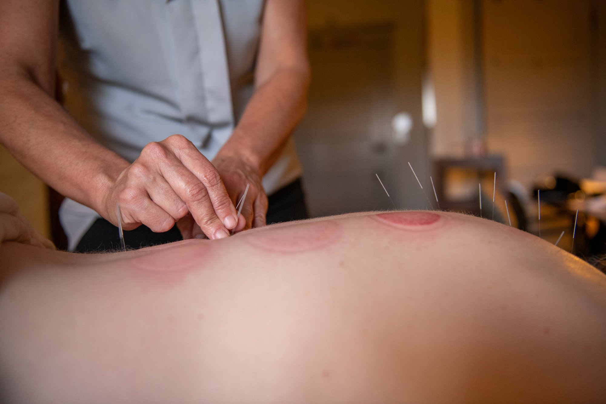 julie-acupuncture-54.jpg